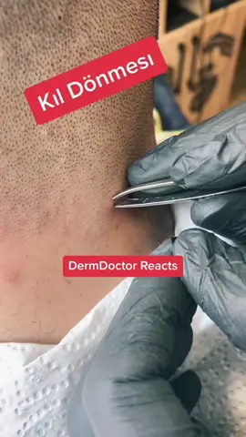 Which score do you agree with @Blackandwhite #ingrown 