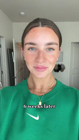 I’m actually SHOOK!!! got masseter jaw botox to help with clenching my jaw at night + it’s made the BIGGEST difference in my jaw pain and working that muscle so much🫶🏼 #botox #botoxbeforeafter #masseterbotox #massetermuscle #masseterinjection #jawbotoxresults #jawbotox 