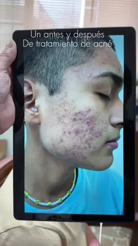 #acne #viral #capcut #foryou #foryoupage #skincare #rocutan #antesedepois #tiktok 