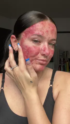 ❤️ #acnepositivity #acneskin #acnejourney #acnefighter #acneproneskin #acnecide #texturedskin #acne #acnejourney🥺 