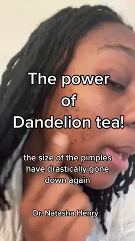 I’m honestly in shock. The power of #dandelion tea is amazing. Dandelion has great anti inflammatory and antimicrobial properties so its not really surprising that it helped to reduce the size of my pimples. #acne is an inflammatory skincare condition so anti-inflammatory agents are key.  #acnetreatment #dandeliontea #healingherbs #diyskincarehacks #diyskincare #skincaretips #skincare #drnatashahenry #howtotreatacne #acneremoval 