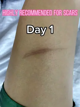 This is your sign to try this product! Thank you Scarminator!!! 🥺❤️ #scarminator #scarminatorcream #scarminatorsoap #scarminator2in1soap #scarminatorpeklatremover #scarminatorglowlotion #skinsensation #scarminatorbyskinsensation #scarminatorglowtonic #mynewbudol #fyp #foryou #foryoupage #beforeandafter #tiktokfinds #legit #darkareas #skinproblems #greatfinds #scarsoap #peklatcream #skincareph #fypシ゚viral #fypシ゚ 