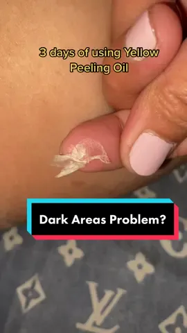 #yellowpeelingoil #clarityessentialsyellowpeelingoil #peeingoil #darkareasolution #darkunderarmsolution #whiteningcream #clarityessentials 