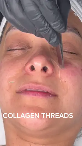 DEEP FACIAL CLEANSING + COLLAGEN THREADS #københavn #copenhagen #antiaging  #facialtreatment  #collagenthread  