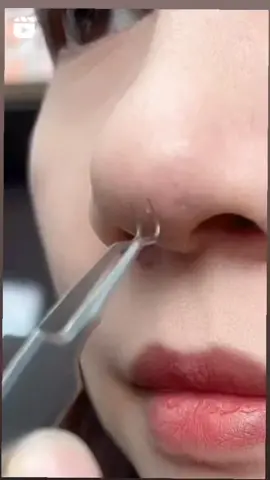 #blackhead #blackheads #blackheadextraction #blackheadremovals #head #cleaning #beautyroutine  #satisfying #removal  #visage #routine  #soin #soinvisage #soins #satisfyingvideo #satisfaction #pimple #pimpleremove #acne #acneskin 