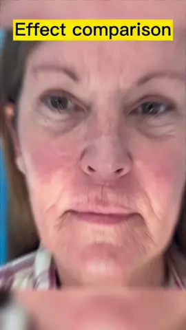 Can you believe this is 70 yeas old skin?#wrinkles #wrinkle #wrinkletreatment #antiaging #nobotox #goodbyewrinkles #byewrinkles #saynotowrinkles #us #removewrinkles #usa_tiktok 