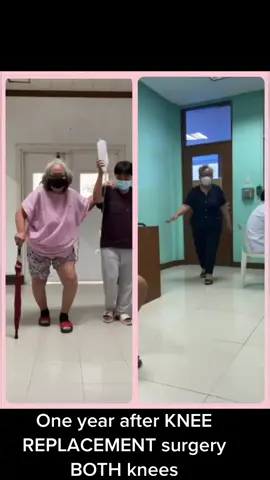 Our 69 y/o patient one year after surgery, walking PAIN FREE and with NO ASSISTANCE following TOTAL KNEE ARTHROPLASTY (resurfacing) of BOTH knees for SEVERE OSTEOARTHRITIS (Posted with permission). OSTEOARTHRITIS, sometimes called 