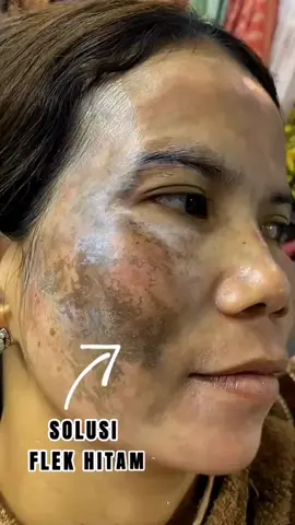 Hubungi 087855953508 untuk konsultasi dan pemesanan #fyp #trending #viral #serum #jerawat #acne #serumviral #GlowUp #serumviral #tki #tkitaiwan #tkihongkong#tkimalaysia 