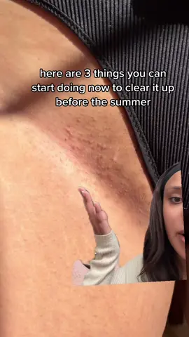 3 products for clearing bikini line razor bumps and ingrowns #bikinicare #shavingtips #razorbumps #ingrownhairs #folloculitis 