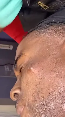 #pimple #poping #verysatisfying #video #extractions #fypシ 