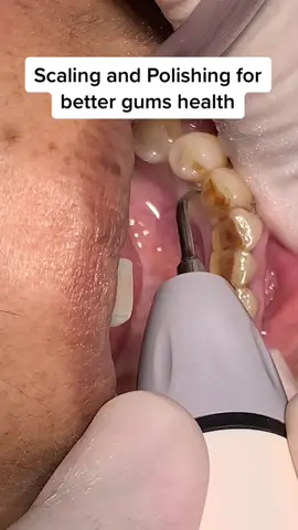 have u do your biannual dental scaling? #klinikgigimalaysia #klinikgigitelukintan #doktorgigi #klinikgigiiman #dentalclinic #clinicadental #klinikgigiselangor #doktorgigimalaysia #tiktokmalaysia #dentisttelukintan #gigi #scalinggigi #dental #dentist #doktorgigianda #malaysiatiktok #gigilubang #gigicantik #gigipalsu #tooth 