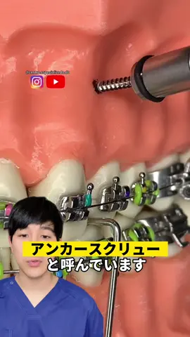 アンカースクリューについて解説します#歯科医師#おすすめ