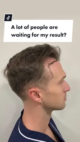 Before and after for man hair transplant #hairtransplant #daclinic #daenglish 