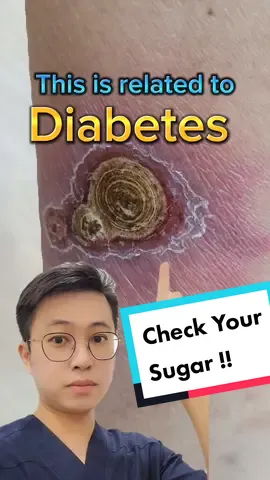 #diabetes #diabeticskin  #impetigo  #ecthyma  #tanyadoktor  #pakarkulit  @Ken Chen Loh 