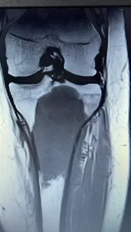 Osteosarcoma on MRI #fy #mri #anatomy #education #fyp #learning #mriiscool #anatomyiscool #foryou #pathology #Science #foryoupage #cancer #osteosarcoma #pediatriccancer 