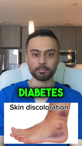 Diabetes can causes discoloration of the skin within your legs and feet. #fyp #podiatry #diabetes #diabetic #feet 
