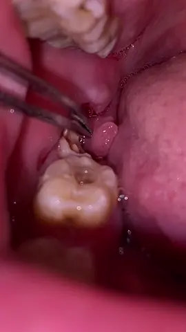 wisdum extraction #dentist #dentista #dental #dentistry #extraction #fyp 