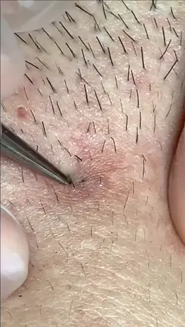 Ingrown hair perfect extraction ✅ #fyp #ingrownhair #blackhead #extractions #pimple #satisfying #perte 