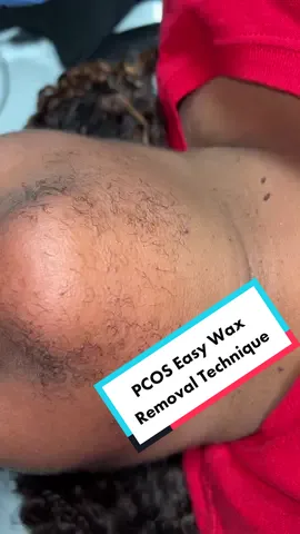 PCOS educational face waxing super easy with @BlackCoralWax 😊 #waxingvideos #estheticianlife #fyp #estheticiantiktok #foryou #foryourpage #satisfying #educational #skincare #skincaretips #skincaretiktok #wax #pcos #pcosfighter #hirsutism #hirsutismwax #hairremoval #blackcoralwax 