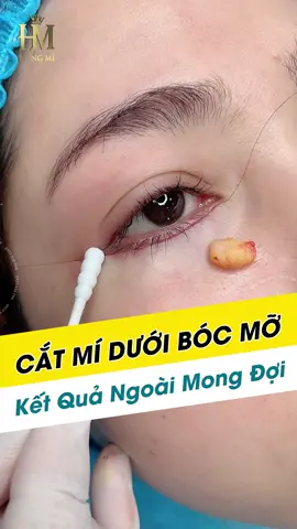 Cắt mí dưới bóc mỡ kết quả ngoài sự mong đợi #xh #lamdep24_7 #pttm #thammy #hangmi90 #chiasekinhnghiemlamdep #catmiduoi