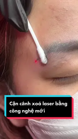 Cận cảnh bắn lông mày laser #TikTokPromote #VietNamToiYeu #phuxamchanmay #daotaohocvienchuyennghiep #daotaohocvienphunxamthammy #xoá_sửa_chân_mày #xoá_xăm #xoaxamlaser #StarRailChallenge #viral #xoaxamhieuqua #xoaxamantoan #xoaxam @Clé beaute by Linh @Nguyễn Thuỳ Linh 
