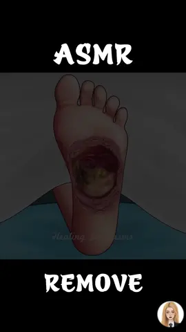 ASMR Addressing posterior heel ulceration animation - Plantar fasciitis treatment