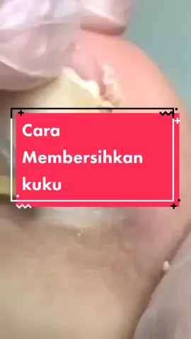 #setguntingkuku #ingrownnail #cantengen #fyp #tiktokshopindonesia 