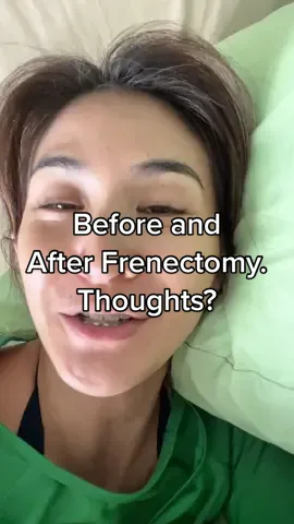 What do u guys think? 💭 #frenectomy @Doc Gemma 🦷 