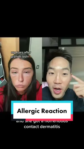 #duet with @bouje elephant #grandelash #dermatologist #dermdoctor #drdavidkimderm #skincare #allergicreaction #allergy #contactdermatitis #eyelashes #eyelashserum #skintok #LearnOnTikTok #makeup 