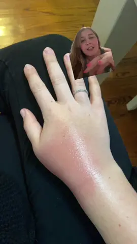 Bugbite update: not doing well #greenscreen #mosquito #mosquitos #mosquitobites #allergy #allergictomosquitoes #sorrowssorrowsprayers #bugbite #bugbites #itchy #uncomfortable #umcomfy #update 