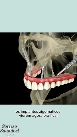 Agende uma consulta de avaliação aqui na Clínica. 💙 #impantesdentarios #dentistaemsaopaulo #dentistanotiktok 