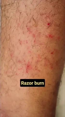 Use a sharp and quality razor like the bronte safety razor to prevent razor rash and ingrown hairs in the future! Video via @Dr Simi Adedeji 
