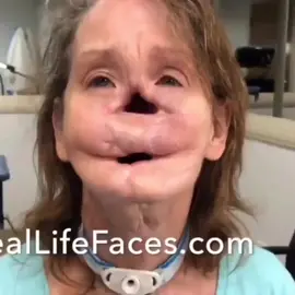 Its amazing what facial prosthetics can do! 