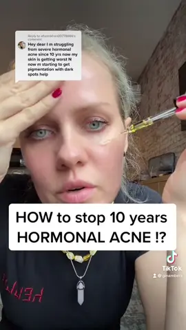 How to stop HORMONAL ACNE ???  #howtogetridofpimples #howtogetridofacne #naturaltreatmentacne #getridofacne #pimplecure #acnecurejourney #hormonalacnehelp 