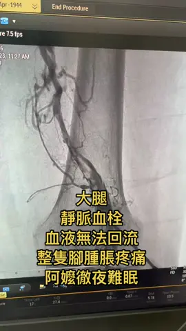 #靜脈栓塞#靜脈血栓 #靜脈曲張 #血栓#下肢靜脈#導管檢查#DVT #deepveinthrombosis 