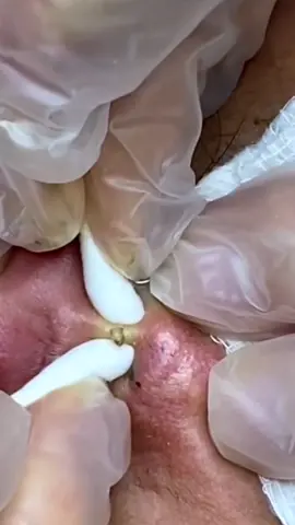 #granos #espinillas #granosyespinillas #granolandia #placer #parati #pimple #pimplepop #satisfying #blackhead #ingrownhair #fyp #relax 