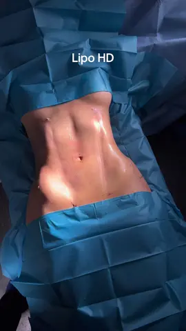 LIPOSUCCIÓN DE ALTA DEFINICIÓN Con la liposucción de alta definición buscamos conseguir un abdomen fit, con unas líneas de transición muy marcadas. #lipohd #liposculpture #lipo #vaser #microaire #liposuction #Про360 #hipdips #lipohdbarcelona 