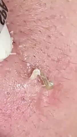 LONG VIDEO 🔥 Satisfying Extraction ✨ Relax #satisfying #pimple #blackheadextraction #pointsnoirs #relax #usa #whiteheads 