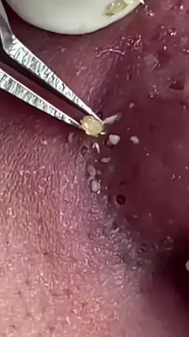 RELAX - Blackheads extraction 🔥#satisfying #blackheadextraction #earblackheads #pimple #blackhead #usa ##estheticianlife #relax #pointsnoirs 