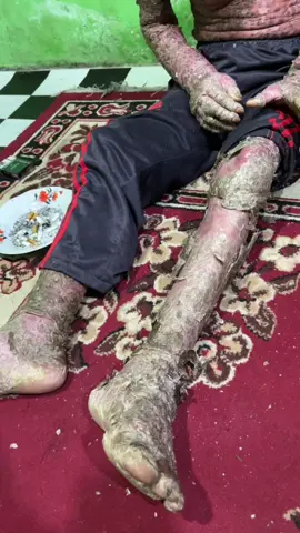 BAPAK INI KENAK PENYAKIT KULIT NON MEDIS, Video selanjutnya ada di YouTube,https://youtube.com/shorts/uYDuMeW_GcM?feature=share #aasalamualaikum🙏salam_santun🙏🙂☺️ #alternatif #stroke #kesurupan #gunaguna #santet #nonmedis #pariaman #tiku #lubukbasung #maninjau #bawan #pasaman #kinali #medan #aceh #padang #padangpanjang #alahanpanjang #agam #pekanbaru #dumai #duri #kerinci #jambi #malay #palembang #jakarta #bandung #kalimantan #fyp #viral #terending #fypvidio 😊😊😊🙏🙏🙏