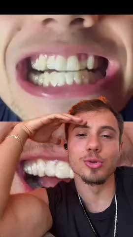 #collage avec @Victor gatinho pulando dançando happy happy happy #invisaling #brackets #clearcorrect 