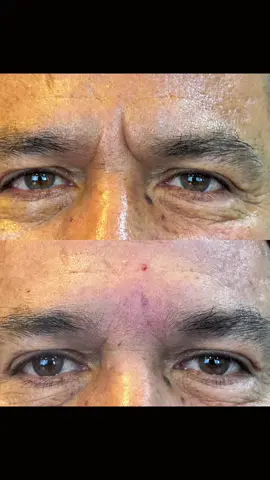 Ácido Hialuronico en entrecejo !  El tratamiento con ácido nos ayuda a rellenar las arrugas profundas del entrecejo dando a tu rostro un efecto más fresco.  #acidohialuronico  #entrecejo  #lineasdeexpresion  #relleno  #arrugasdelentrecejo  #procedimentosesteticos  #bogota  #estetic 