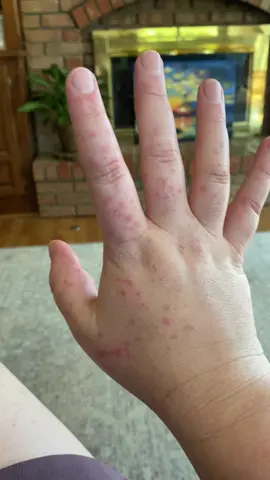 So i though i would ask the world of TikTok, if anyone has had rashes like this on their hands. Its only on my hands and comes and goes. They also dont  itch  at all. I have been sick for 4 weeks with a bad cough. Took 4 covid test all negative. Even went to urgent care two  weeks ago. To be told my lungs  aound find the cough ahould go away and they had nonidea what this rash was. At 1st she thiugh hand,foot and mouth but since they will fade away by the end of the night she didnt it was that. No one else in my family has it. #m#medicalm#medicaladvicer#rashh#helpme