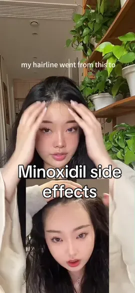 Minoxidil side effects! Watch this before you start minoxidil! #minoxidil #minoxidilresult #minoxidilsideeffects  #hairgrowth #hairlinerestoration #hairlinereceding #recedinghairline #babyhair #fypシ #hairdensity 