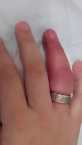 Como remover um anel preso do dedo: Dicas úteis e práticas!