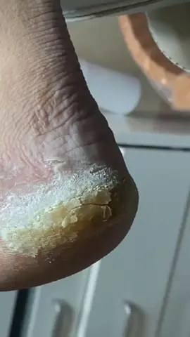 Removing parmesan flavored cheese feet 👣 #footpain #fyp #viralvideo #satisfying #callusremoval #painful #podiatry #satisfyingvideo #myfootarekillingme #callus #trendingvideo #calluses #healthyfeetpodiatry #pedicure #crackedfeet @FootWorks Relaxing 