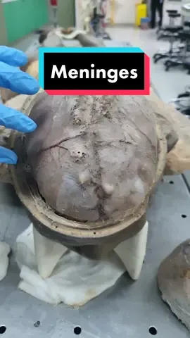 #CapCut #anatomy #medicalmuseum #medical #medicine #upnm #meninges #brain #cadaver #cupid #doctor 