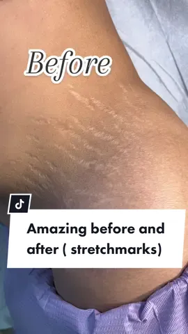 In 2 days itll only be 5 weeks since her 1st session 🥳 these results are amazing. She followed the aftercare instructions and is healing very nicely. Before she had deep textured stretch marks and after you can see how they filled with up with a flatter appearance using her natural collagen 😇 so proud of her 👏🏽 #fyp #stretchmarkremoval #stretchmarksolution #stretchmarkrejuvenation #inklessstretchmarkremoval #parati #summerbody #classiclashextensions 