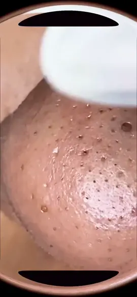 #satisfying #fyp #pimples