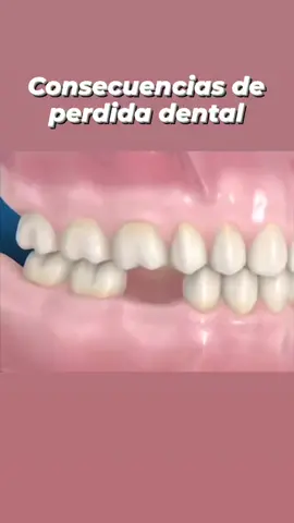 La importancia de reponer los dientes faltantes...